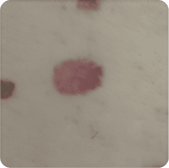 Skin cancer picture 1