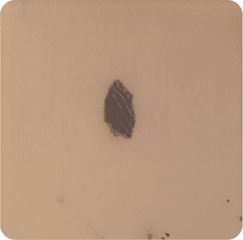 Skin cancer picture 2