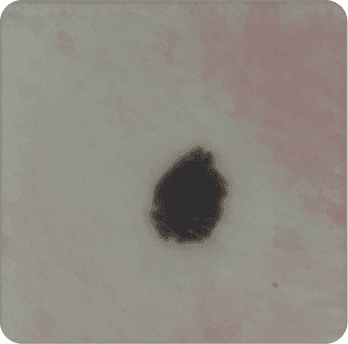 Skin cancer picture 3