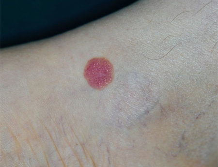 Skin cancer picture 1