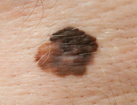 Skin cancer picture 2