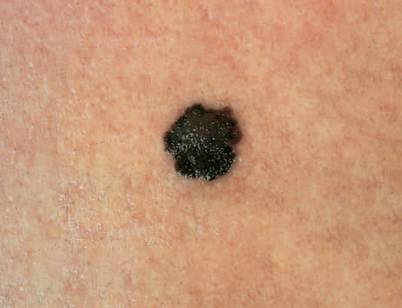 Skin cancer picture 3