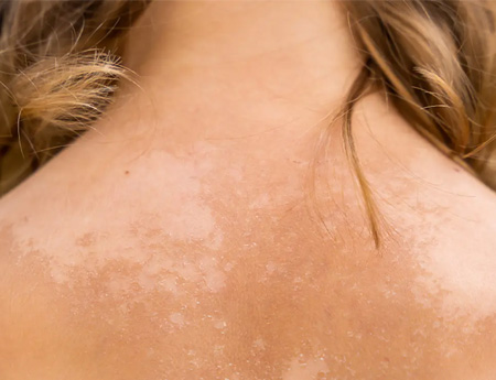 White Spots