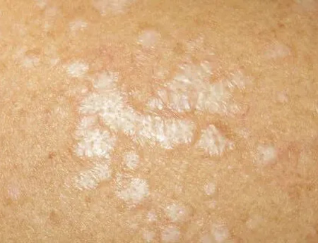 White spots